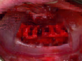 Eingesetzter Reduction Guide