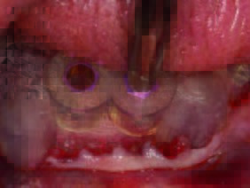 ExpertEase™Guide in situ