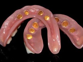 Fertige Konusprothesen für den Unter- und Oberkiefer (von basal)...