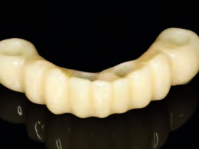 Gefrästes und poliertes Provisorium aus Temp Premium