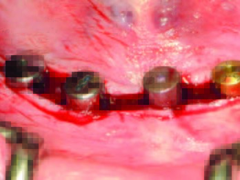 Gingiva- oder Sulkusformer in situ