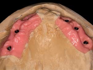Gingivahöhen als entscheidender Parameter für die Abutmentwahl