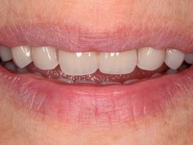 Harmonisches Zusammenspiel von Inzisalkanten und Lippenbild