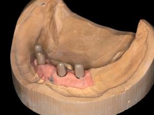 Hochglanzpolierte Zirkonoxid-Patrizen für den Unterkiefer, in A3 eingefärbt.
