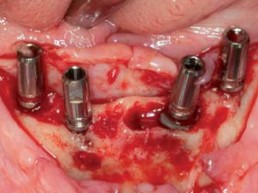 Im Unterkiefer inserierte ANKYLOS-Implantate