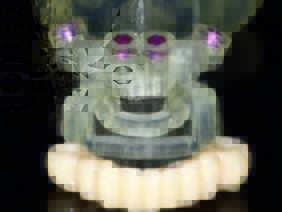 Im Überblick Provisorium Reduction Guide ExpertEase Schablone und der stereolithographisch gefertigte Kiefer