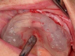Implantatachspositionierungsschablone in situ (aus Orthocryl gefertigt)