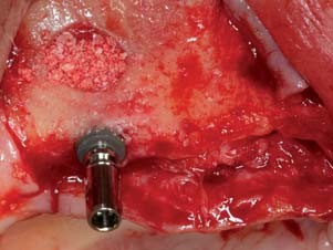 In Regio 16 eingebrachtes ANKYLOSB Implantat darüber mit Bio-Oss ausgefüllter Sinus
