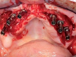 In den zuvor geglätteten Alveolarkamm des Oberkiefers inserierte ANKYLOS-Implantate