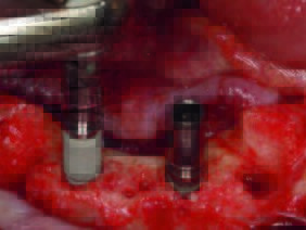 Inserierung der Ankylos® C_X –AImplantate