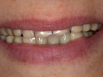 Insuffiziente und ästhetisch unzureichende Altversorgung