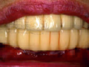 Interimszahnersatz in situ