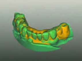 Modellation des Sofortprovisoriums im CAD-Programm