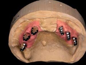 Modellsituation Oberkiefer nach Abformung
