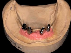 Modellsituation Unterkiefer nach Abformung