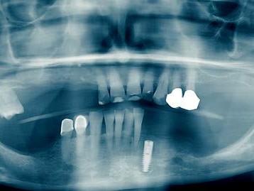 Postoperatives OPG nach Implantation regio 33