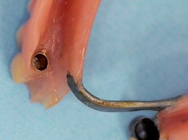 Prothese von basal mit SynCone-Kappe