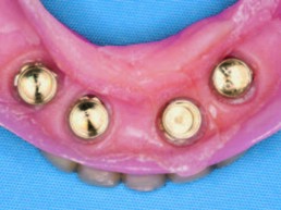Prothese von basal – eingearbeitete SynCone Kappen (Bild Leihgabe der FA Dentsply implants)