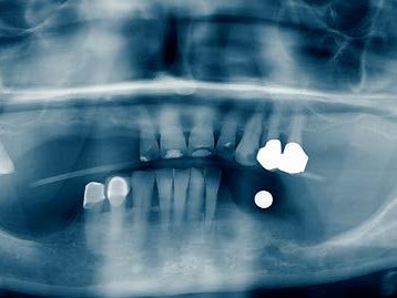 Präimplantologische OPG-Messkugelaufnahme
