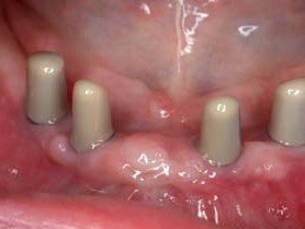 Reizfrei adaptierte Abutments mit Patritzen im Unterkiefer