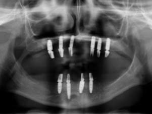 Röntgenkontrollaufnahme der final eingeschraubten Abutments