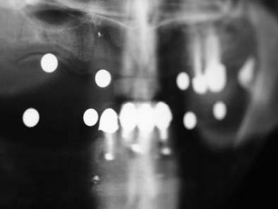 Röntgenologische Ausgangssituation (fotografiertes OPG)