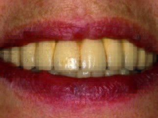 Schlussbisssituation