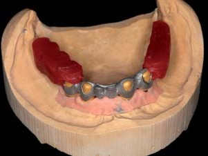 Spannungsfreier Modellguss (UK) mit Kontrollschlüssel für Bisslage und -höhe.