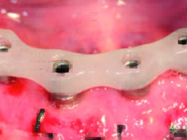 SynCone Abutments in situ mit Einbringschlüssel
