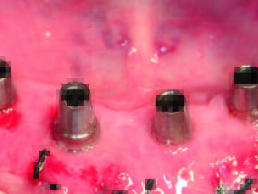 SynCone Abutments in situ