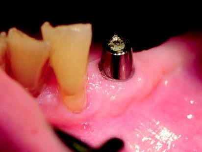 SynCone-Aufbau in situ zwei Jahre post insertionem