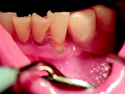 Teleskopierende Arbeit in situ