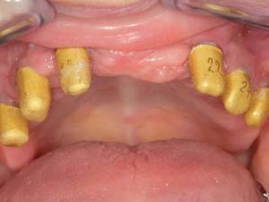 Verklebte Primärteile mit aufgesteckten Galvano-Sekundärteilen