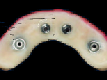 Versäubertes PMMA-Provisorium von basal