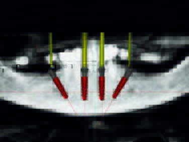 Von der SimPlant-Software berechnetes OPG