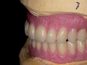 Wachsaufstellung der geplanten Neuversorgung auf dem Modell …