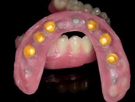 Wachsaufstellung mit Matrizen (von basal) für die Ästhetikanprobe