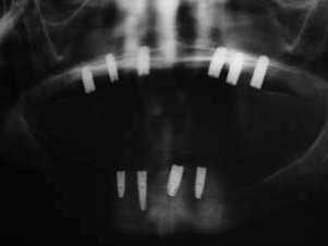 Wie geplant positionierte Implantate (Röntgenkontrollaufnahme nach Einheilung)