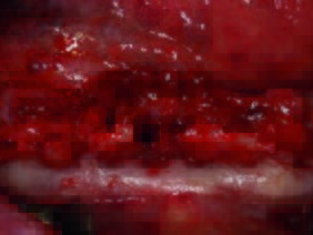 Zustand nach Entfernung der Restzähne