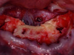 Zustand nach Glättung des Alveolarfortsatzes im Frontzahnbereich