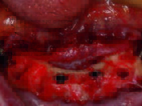 Zustand nach Insertion der angulierten Implantate