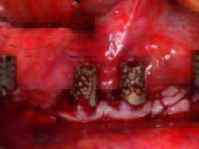 Zustand nach typischem Naht-Wund-Verschluss