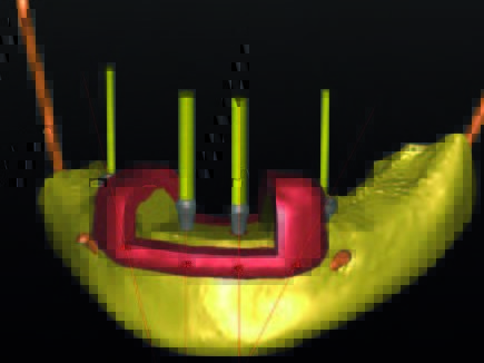 ... mit dem ExpertEase Guide.