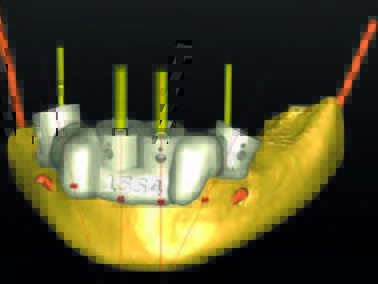 ... nach Bearbeitung mit dem Reduction Guide ...