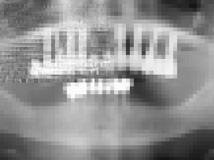 Präoperatives Orthopantomogramm