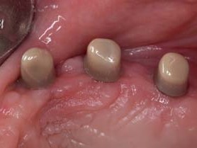 … und ebenso im Oberkiefer aufgrund ihrer individuellen Ausformung