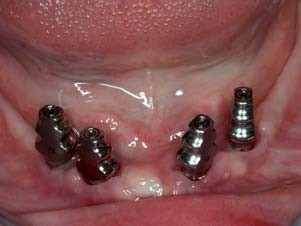 … und im Unterkiefer