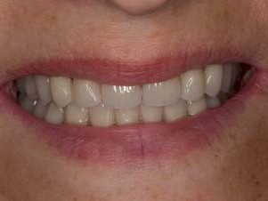 … und intraoral beim Ästhetik-Check mit der Patientin