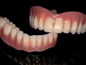 … und von frontal mit Gingivaanteil.