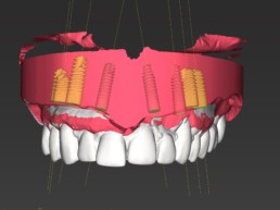 Abb. 4: Virtuelle Planung der Zahnimplantate mit gematchten Zahnersatz